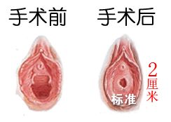处女膜修复,处女膜修补